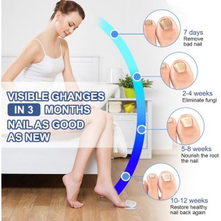 Лазерен уред за терапия на гъбички по ноктите