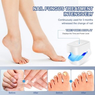 Лазерен уред за терапия на гъбички по ноктите